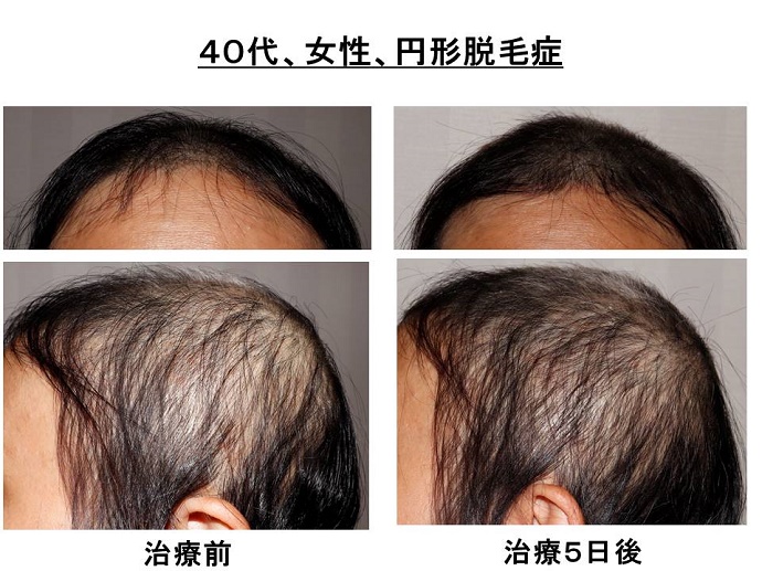 円形脱毛症　病院